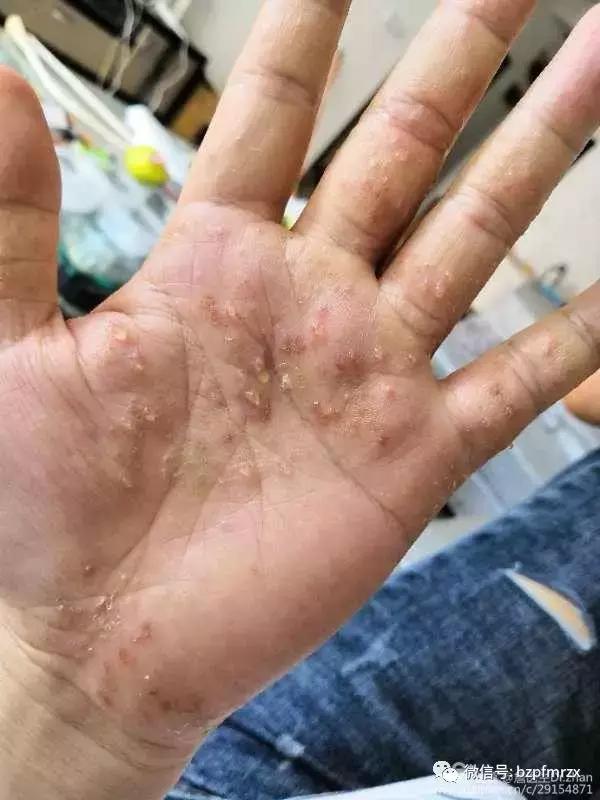 你对汗水疱疹了解多少? 你对汗水疱疹了解多少?