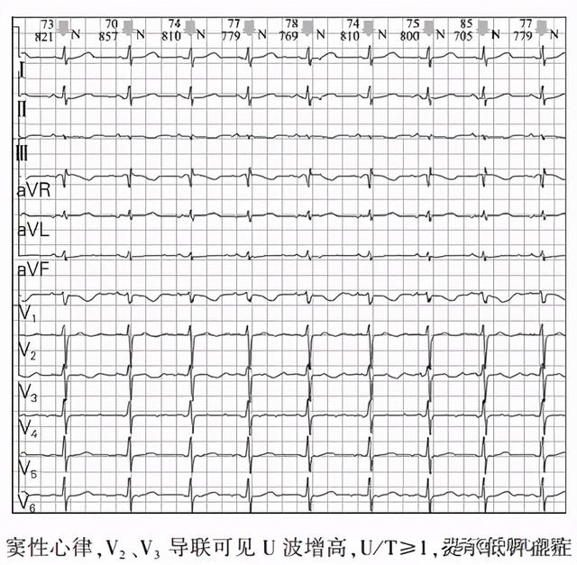 八种qt间期延长类型