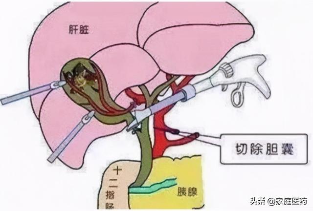 胆囊切除术后 无胆英雄 如何科学饮食 今日头条