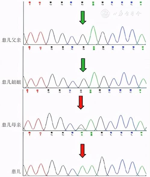 Arse基因突变导致x 连锁隐性遗传点状软骨发育不良的临床